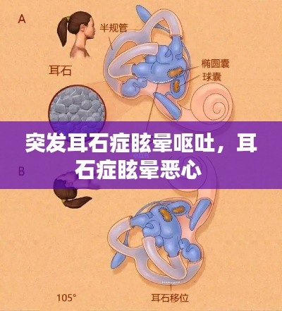 突發(fā)耳石癥眩暈嘔吐，耳石癥眩暈惡心 