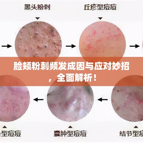 臉頰粉刺頻發(fā)成因與應(yīng)對(duì)妙招，全面解析！